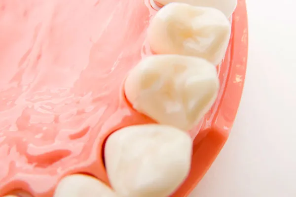 かぶせ物・つめ物の扱っている種類